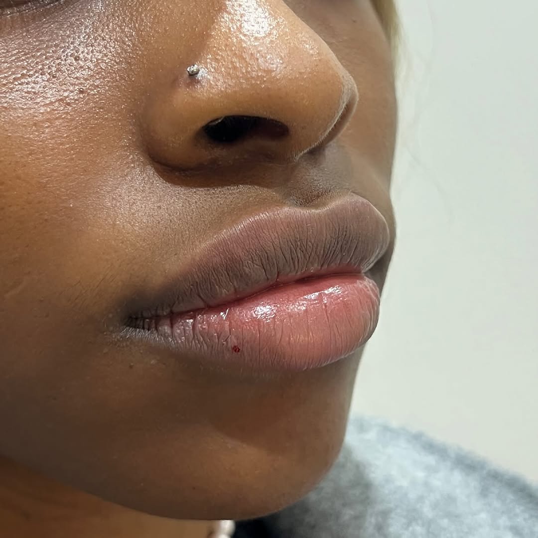An annual 1ml top-up