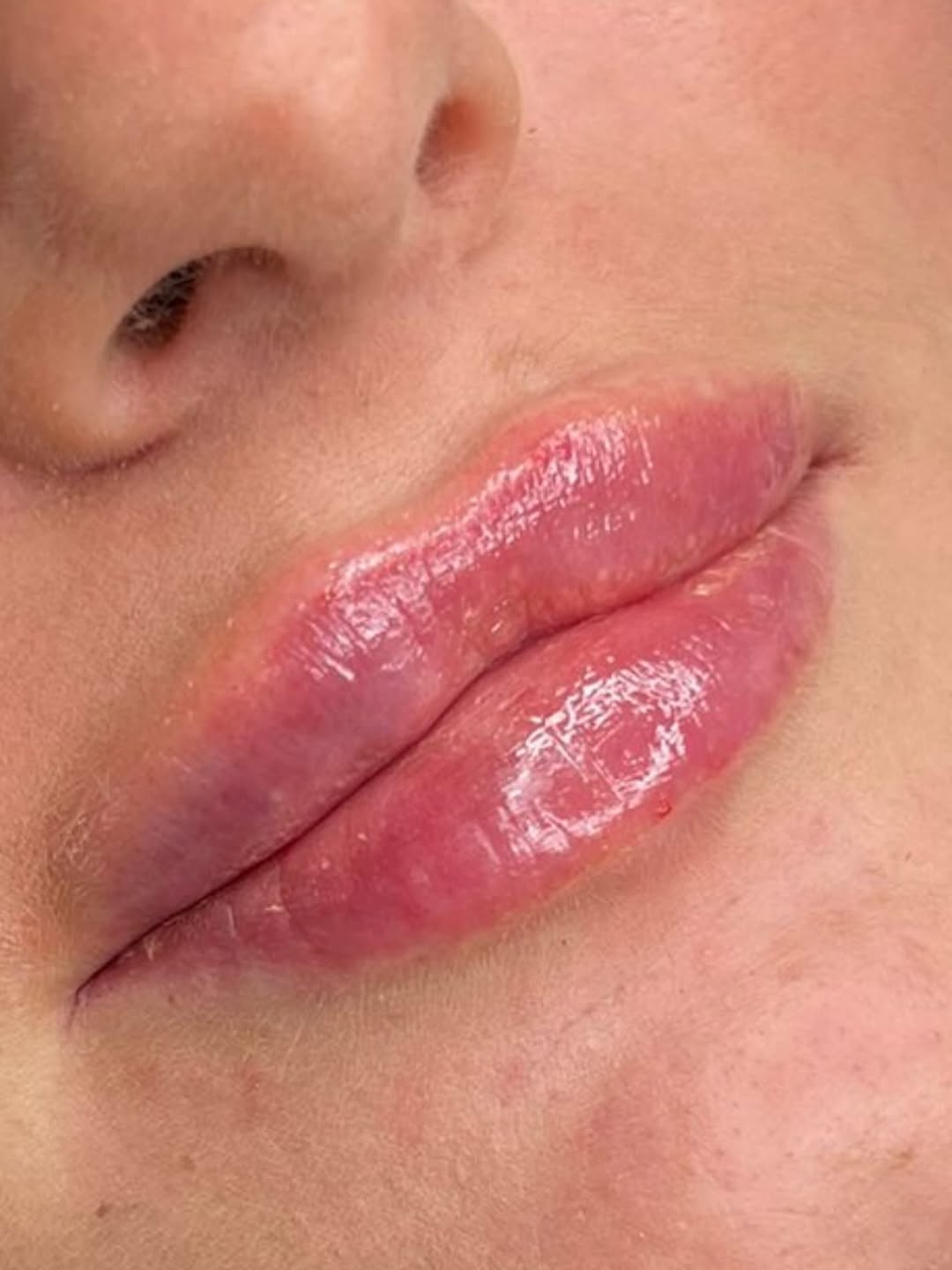 After — Lip filler · 1ml